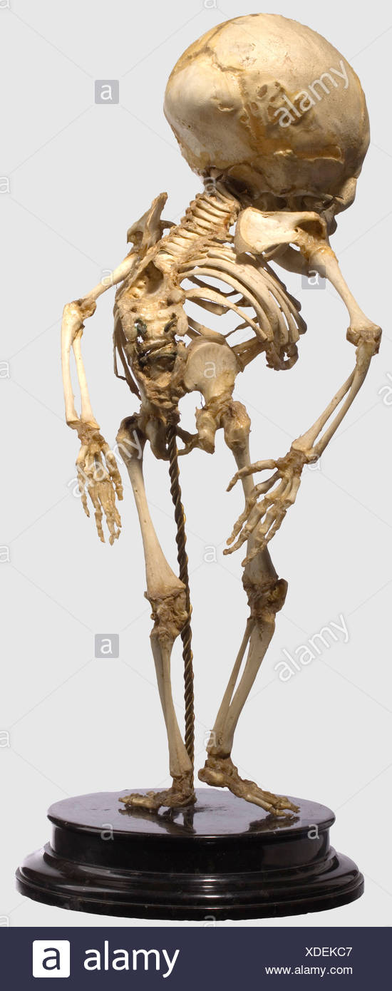 Scoliose Severe Banque D Image Et Photos Alamy