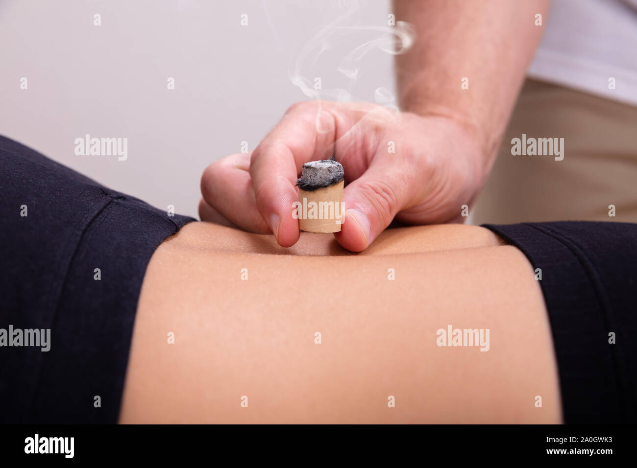 Close-up di un maschio di terapeuta donna subendo Moxa Stick trattamento su una donna indietro Foto Stock