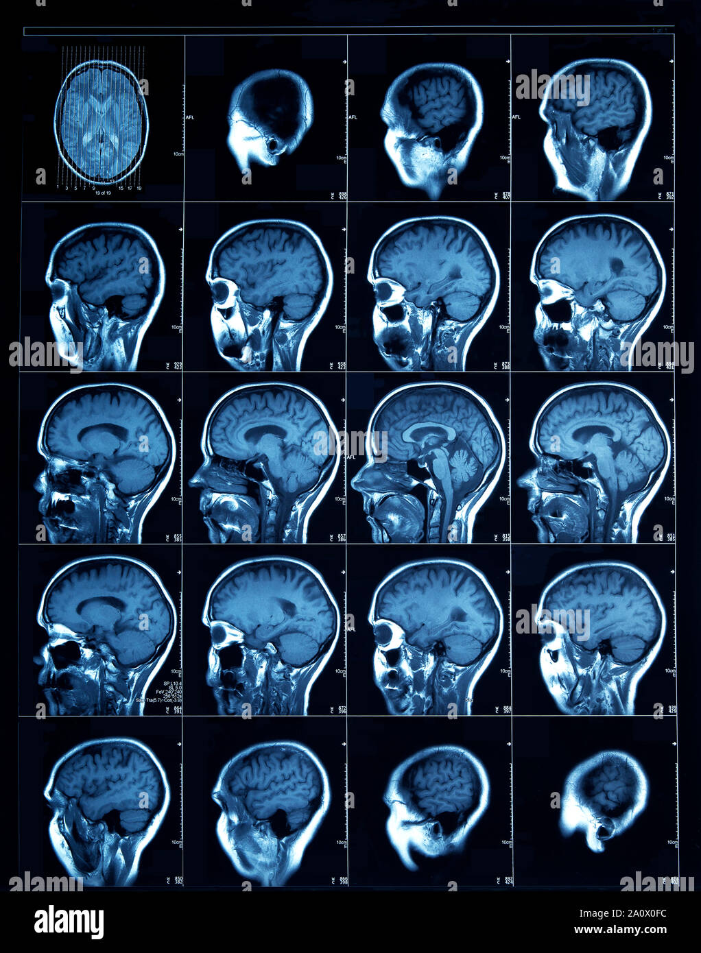 Fette di sezione scansione Tc di una testa umana, mostrando la corteccia cerebrale attraverso le cavità nasali. Foto Stock