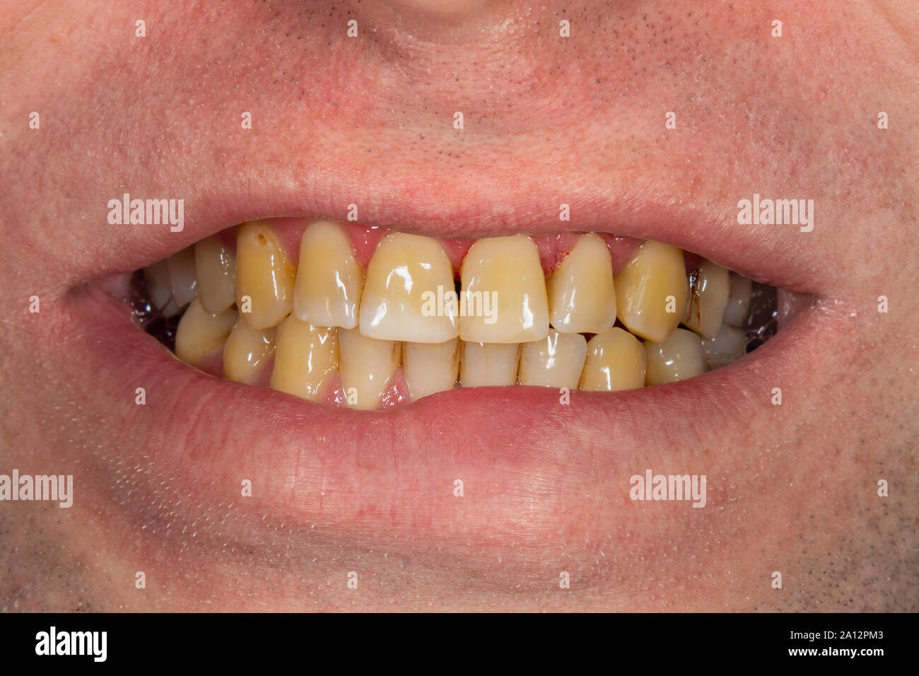 Fumatori, della placca sui denti denti umani dopo il fumo. Resinosi marrone della placca sui denti di close-up. Fumatori concetto del danno Foto Stock