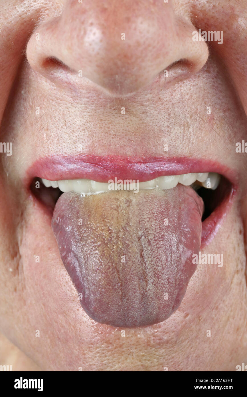 Un'anziana donna senior con metallo- denti in ceramica mostra la sua lingua per un medico terapeuta. Studio macro Foto Stock