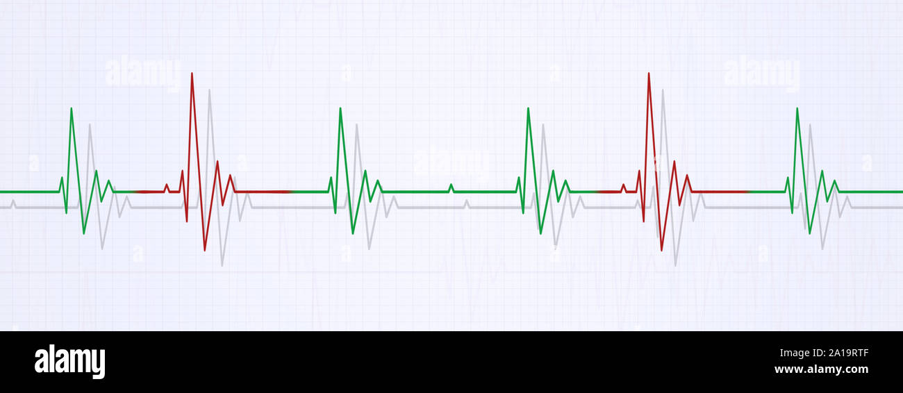 Banner di medici che illustra il battito cardiaco irregolare su ecg. aritmia del cuore Foto Stock