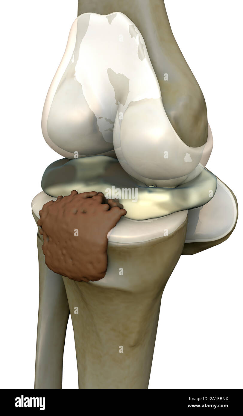 Ginocchio umano, ginocchio, rendering 3d'illustrazione del ginocchio, dolore illustrazione lato del ginocchio, ginocchio x-ray, ginocchio umano malattia Foto Stock