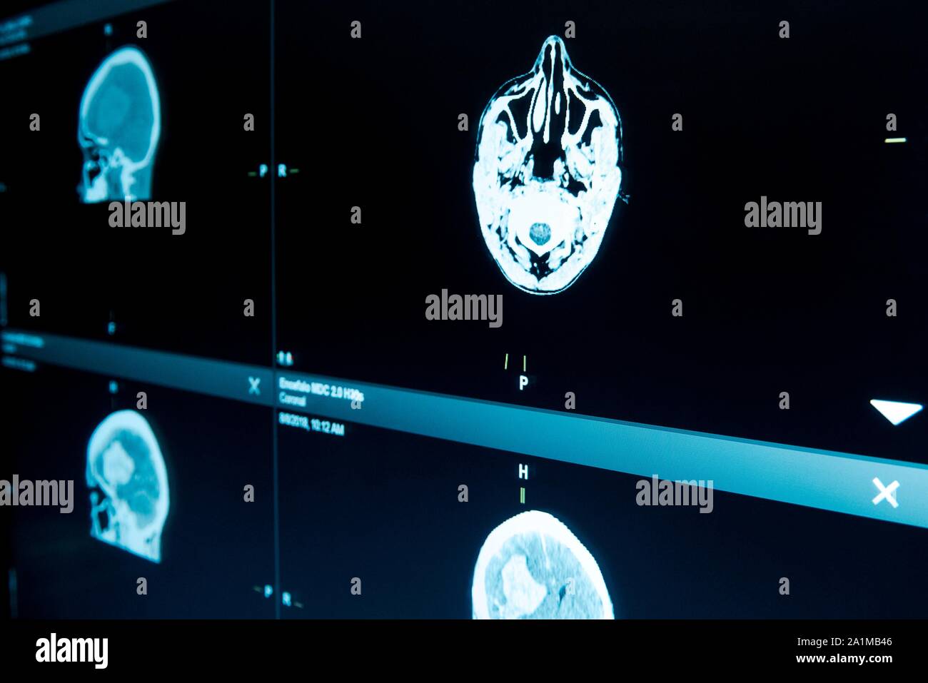 Il monitor mostra una risonanza magnetica (RM) scansioni cerebrali. Foto Stock