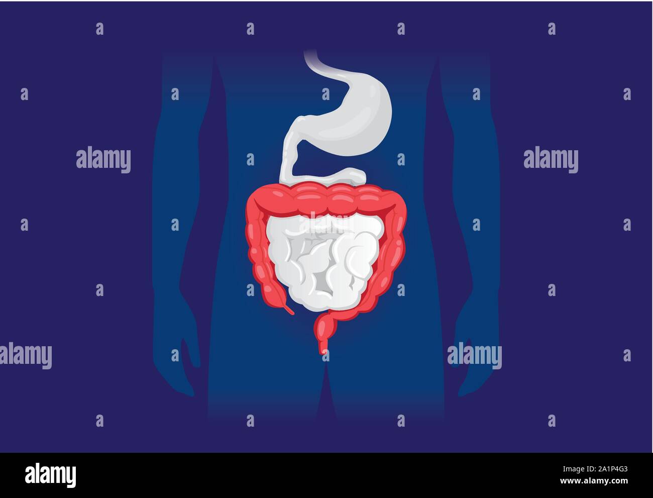 Illustrazione circa sintomo anormale di umana intestino crasso. Illustrazione Vettoriale