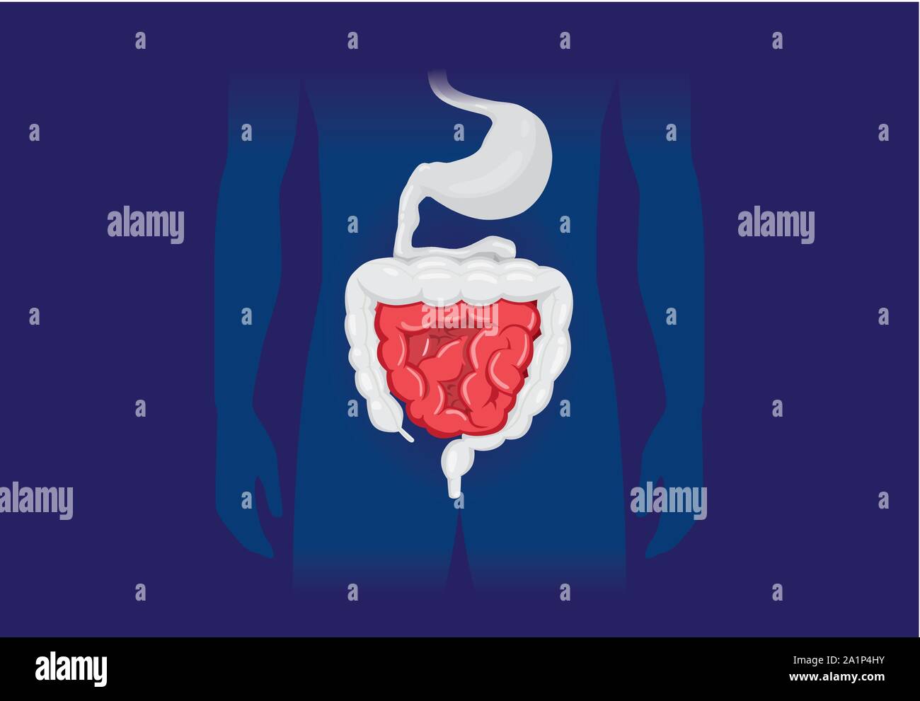 Illustrazione circa sintomo anormale di umana intestino tenue. Illustrazione Vettoriale