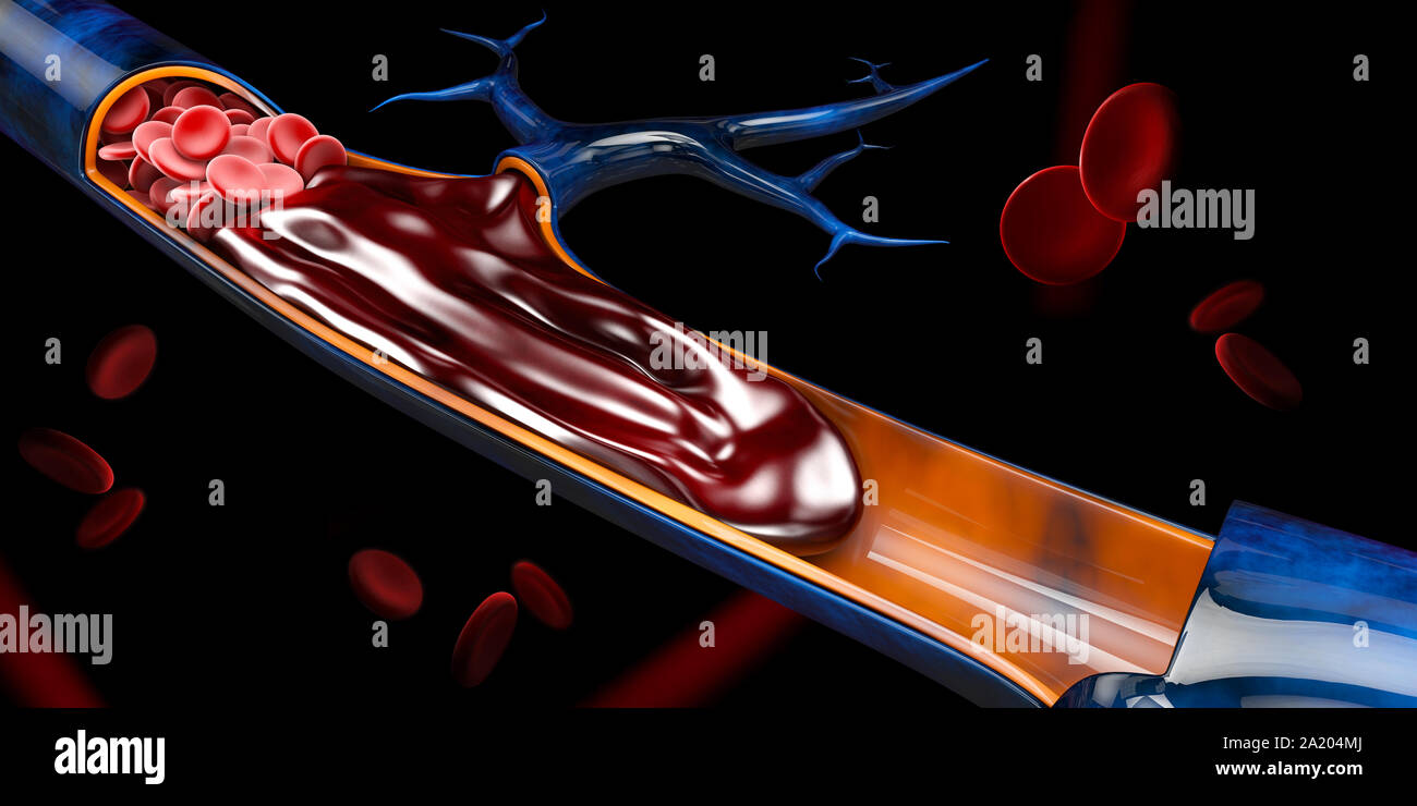 3d illustrazione di trombosi venosa profonda o coaguli di sangue. Embolia. Foto Stock
