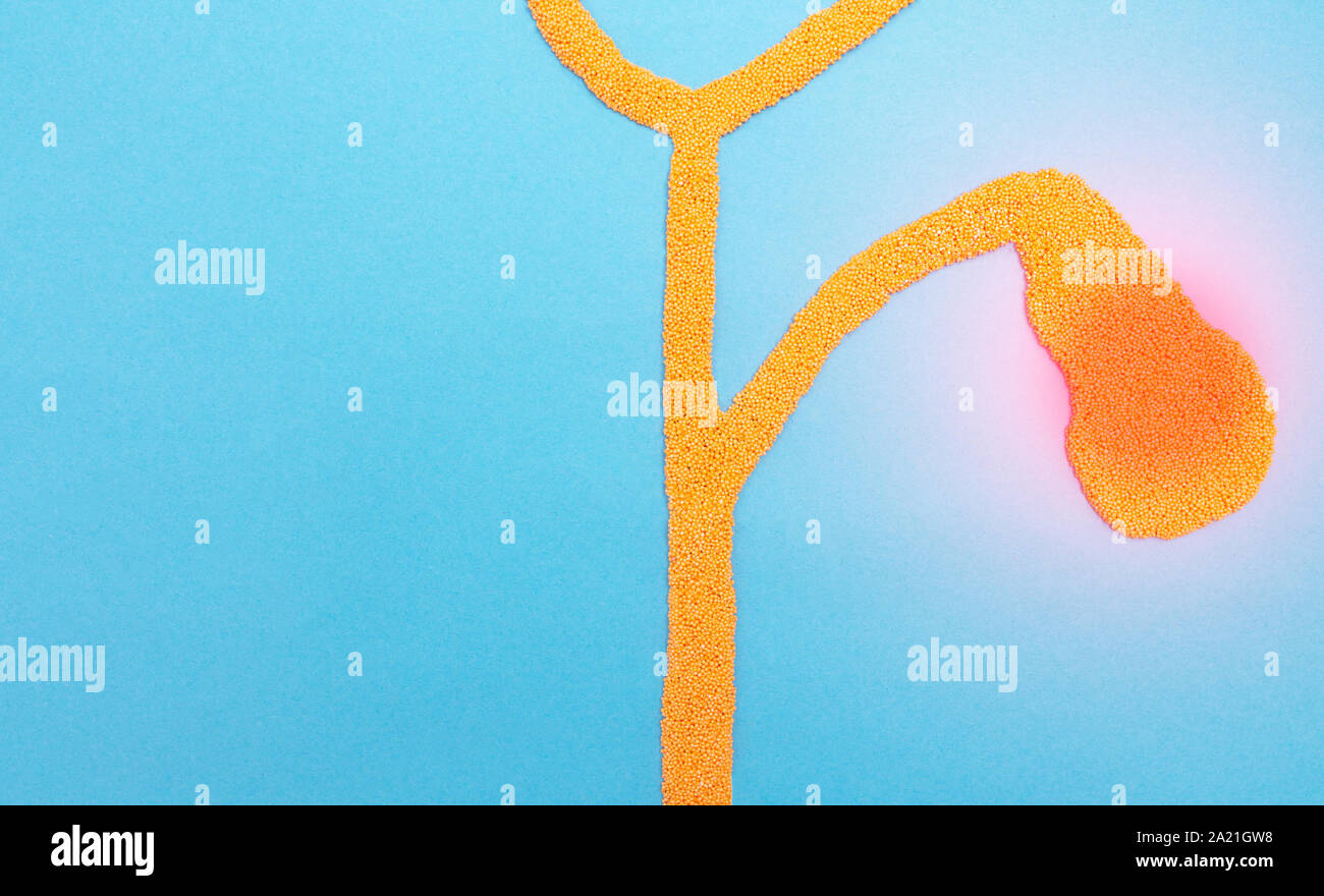 Dotti biliari e della cistifellea di plastilina su uno sfondo blu. Colelitiasi concetto e laparoscopica metodi per la rimozione di calcoli biliari. Chroni Foto Stock