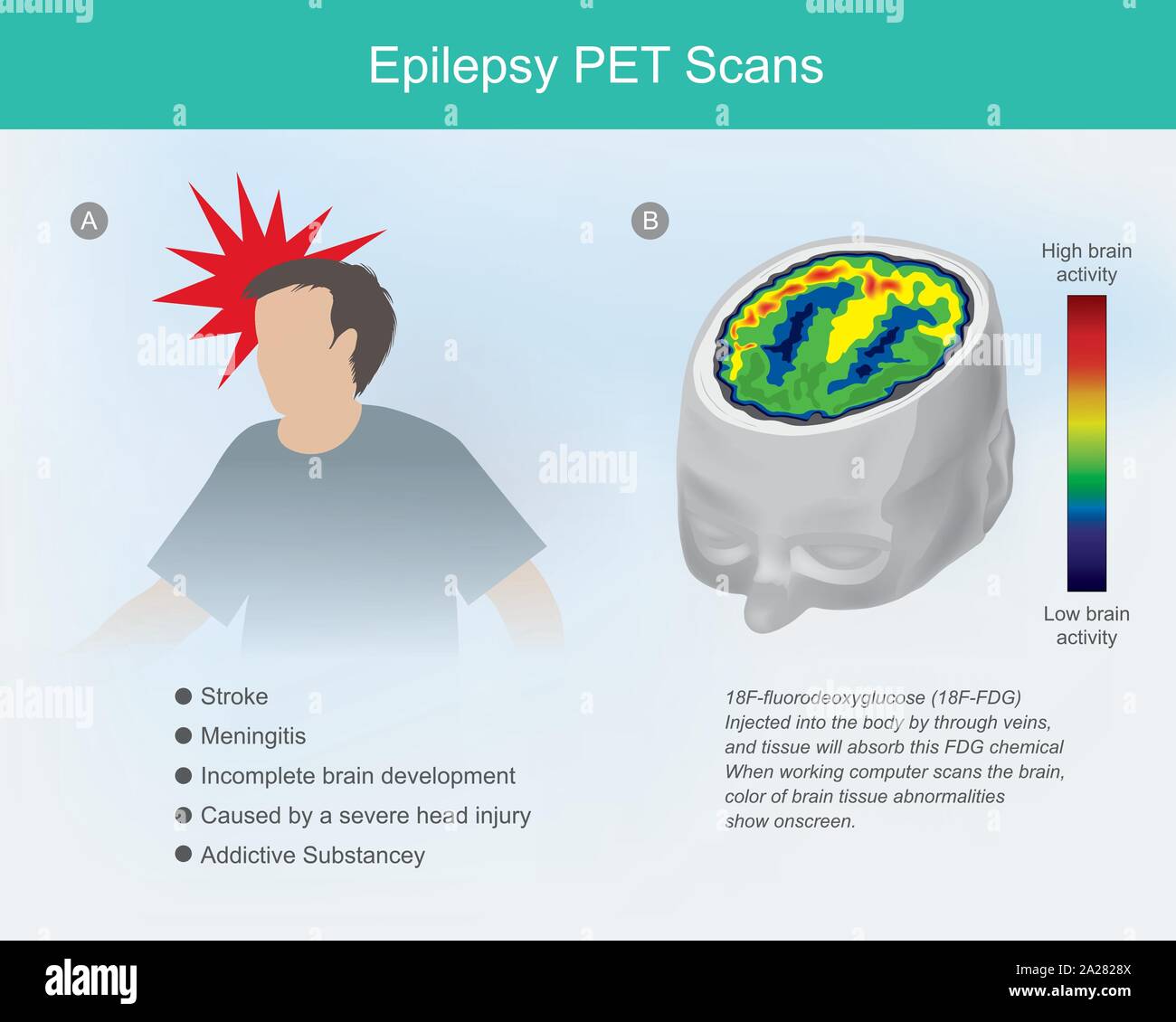 Epilessia scansioni PET. Le cellule cerebrali se commozione cerebrale o epilessia malattia, causare il cervello di malfunzionamento, anormalità può essere rilevato imaging utilizzando Illustrazione Vettoriale