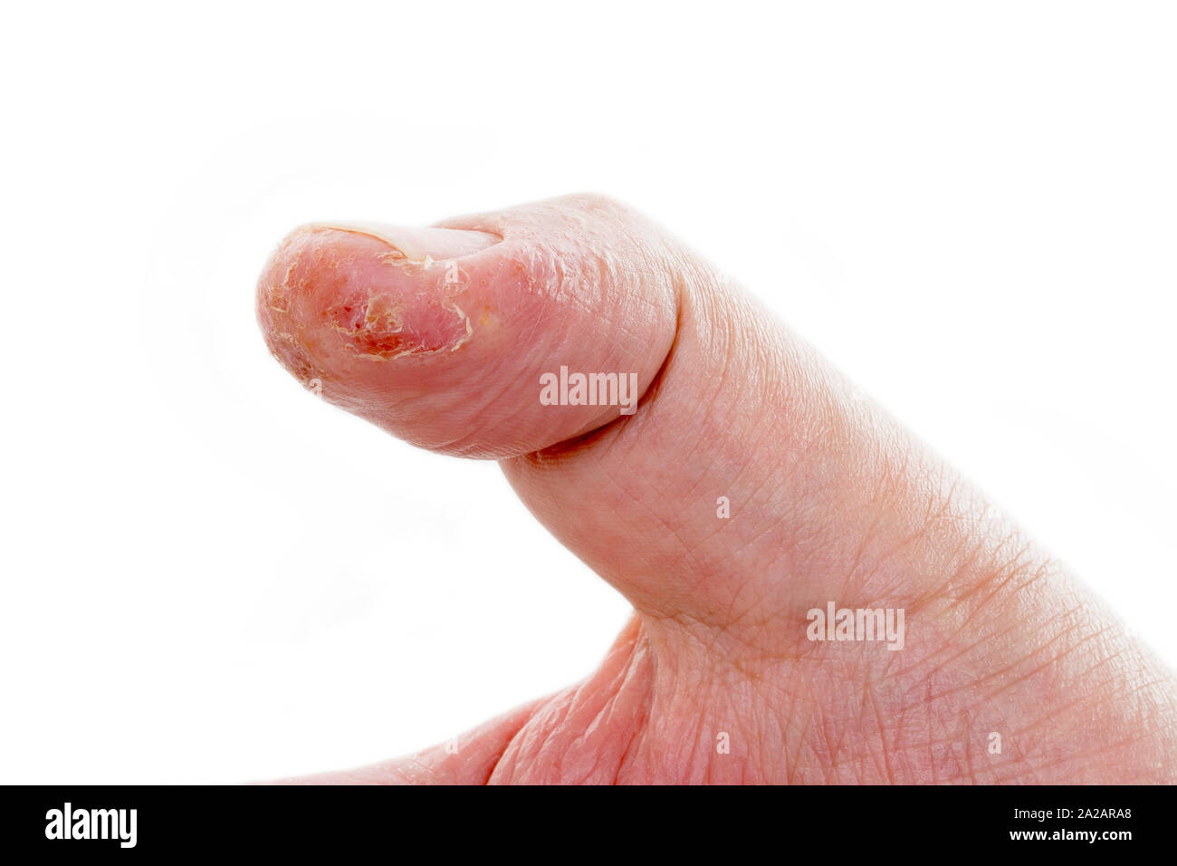 Primo piano della dermatite eczema eruzione cutanea allergica sul pollice maschio con peeling della pelle. . Isolato su sfondo bianco. Foto Stock
