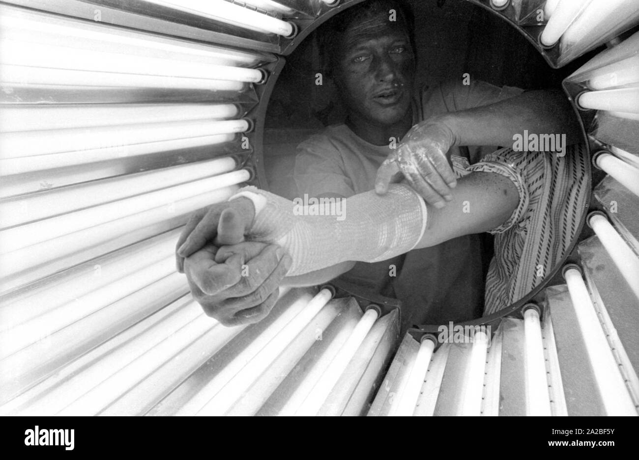 Un braccio intonacata in un tubo luminoso. Qui è stato utilizzato probabilmente "Lightcast 3M', un bendaggio materiale che indurisce sotto luce ultravioletta. Foto Stock