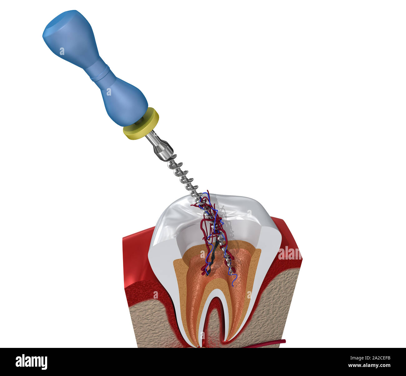 Trattamento canalare processo. 3D illustrazione Foto Stock