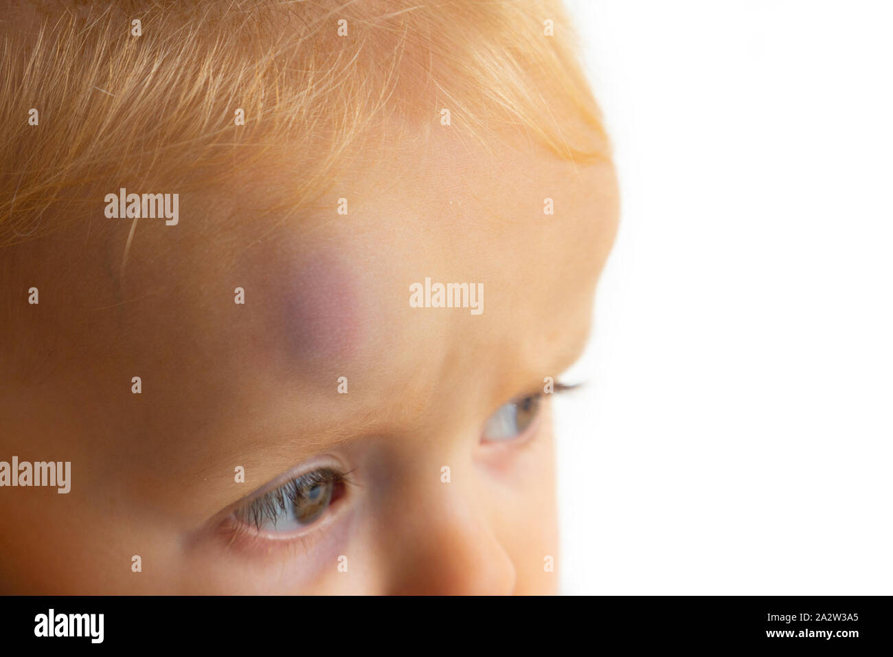 Giovani toddler aventi grandi protuberanza sulla sua testa Foto Stock