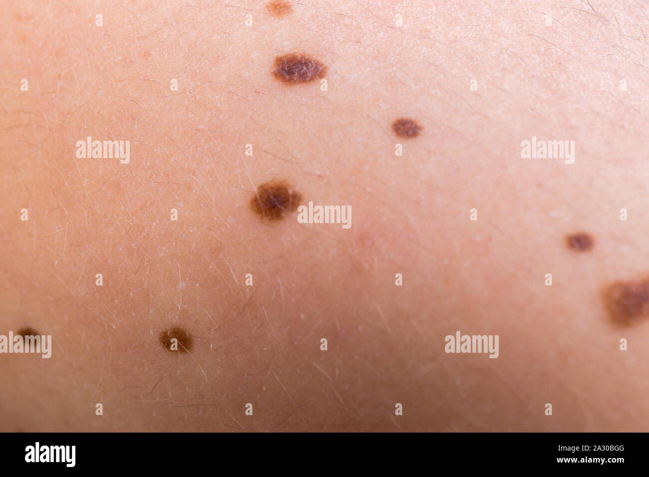 Talpe sulla pelle immagini e fotografie stock ad alta risoluzione - Alamy