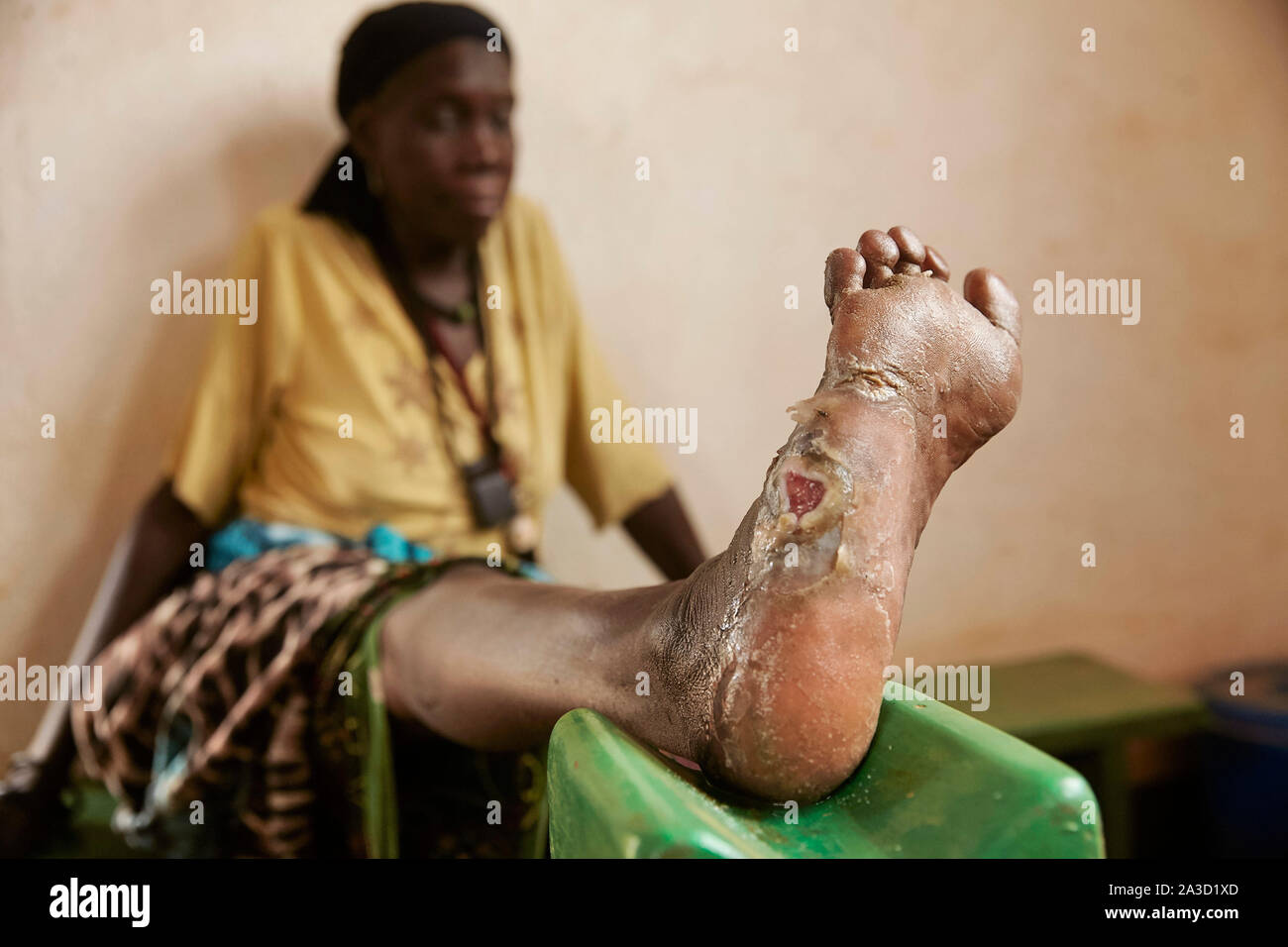 Tsjaad Ciad Mongo Khadidja Douryous (60) lebbra vittima con i suoi piedi e mani 21-6-2016 foto: Jaco Klamer Foto Stock