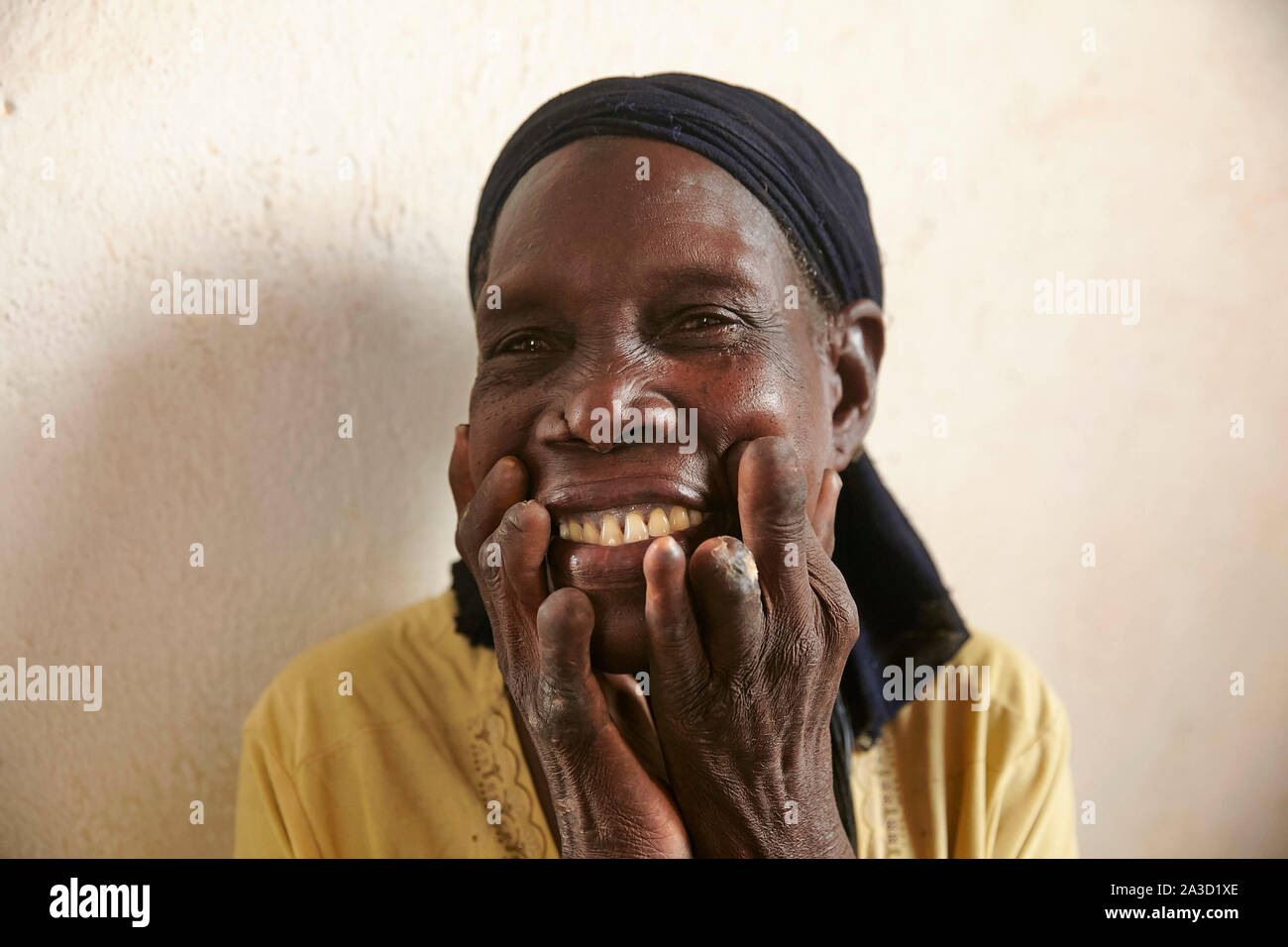 Tsjaad Ciad Mongo Khadidja Douryous (60) lebbra vittima con i suoi piedi e mani 21-6-2016 foto: Jaco Klamer Foto Stock