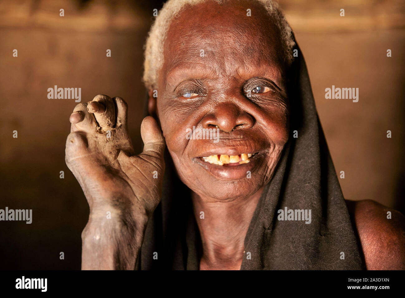 Tsjaad Ciad Mongo Hapsita Derasol (60) lebbra vittima donna 22-6-2016 foto: Jaco Klamer Foto Stock