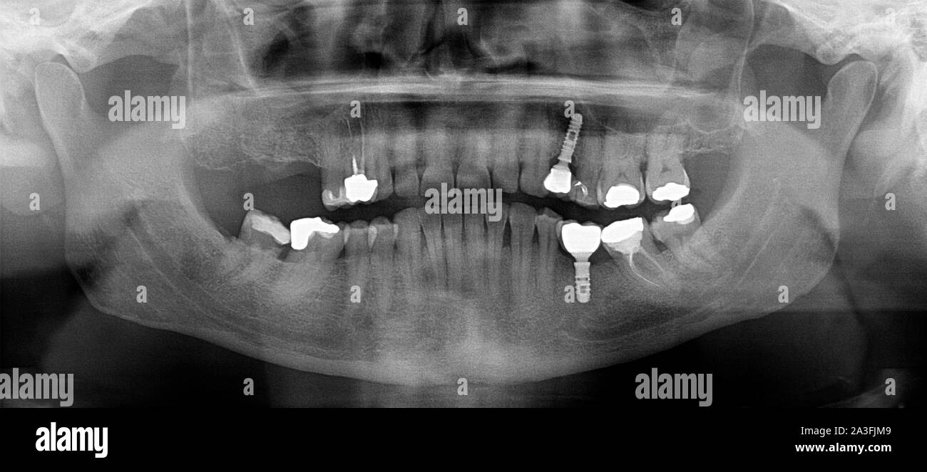 Panoramica di radiografia dentale Foto Stock