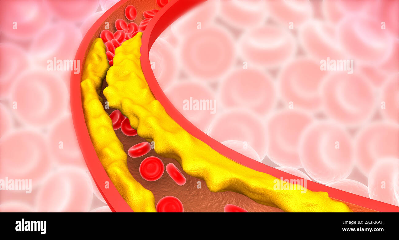Arteria bloccata con colesterolo cattivo. arterie intasate, arteria coronaria placca. 3d illustrazione Foto Stock