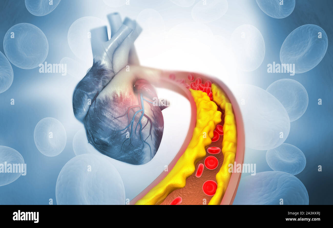 Placca di colesterolo in arteria con cuore umano anatomia. 3d illustrazione Foto Stock