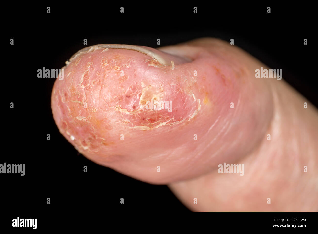 Primo piano della dermatite eczema eruzione cutanea allergica sul pollice maschio con peeling della pelle. . Isolato su sfondo nero. Macro. Profondità di campo. Foto Stock