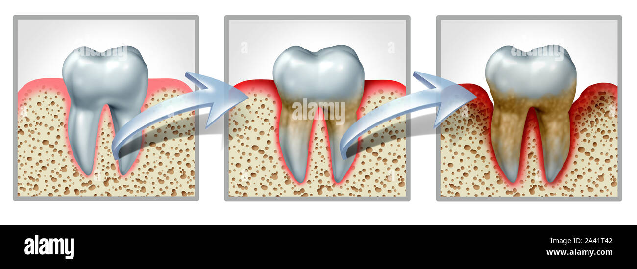 Denti e gengive malattie dentali medici concetto grafico con i denti sani getting gengivite e periodontite con conseguente infiammazione e perdita ossea. Foto Stock