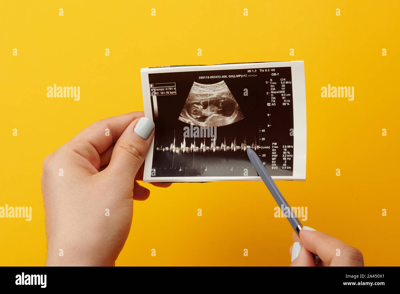 Il battito cardiaco del bambino nel ventre sulla foto di ultrasuoni Foto Stock