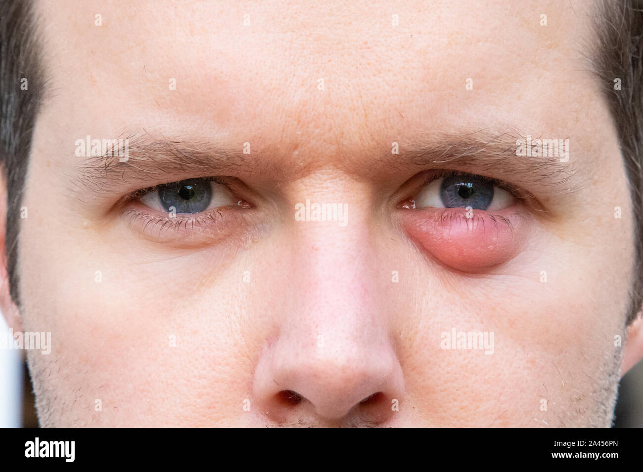 Un uomo con una palpebra gonfia a causa di una infezione. Foto Stock