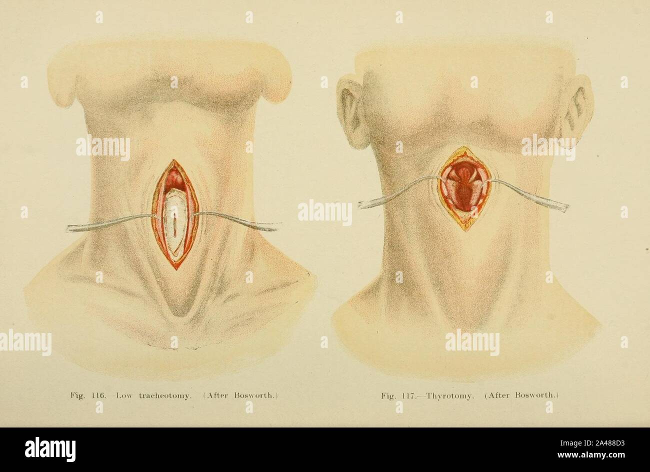 Fig. 116. Bassa tracheotomia. Fig. 117. Thyrotomy. Foto Stock