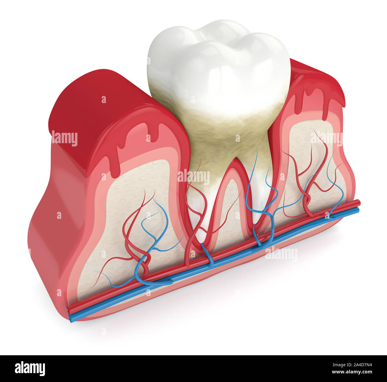 3D render del dente in gengive sanguinanti su sfondo bianco. La malattia periodontale concetto. Foto Stock