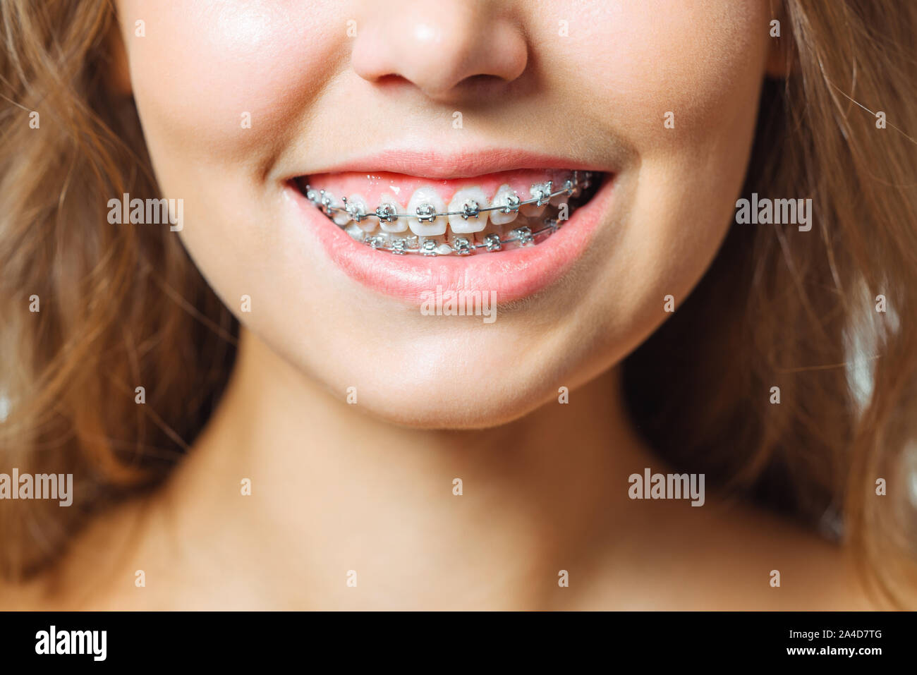 Trattamento ortodontico. Per le cure dentarie concetto. Bella Donna sorriso sano vicino. Primo piano in ceramica e le staffe di metallo sui denti. Bellissima femmina Foto Stock