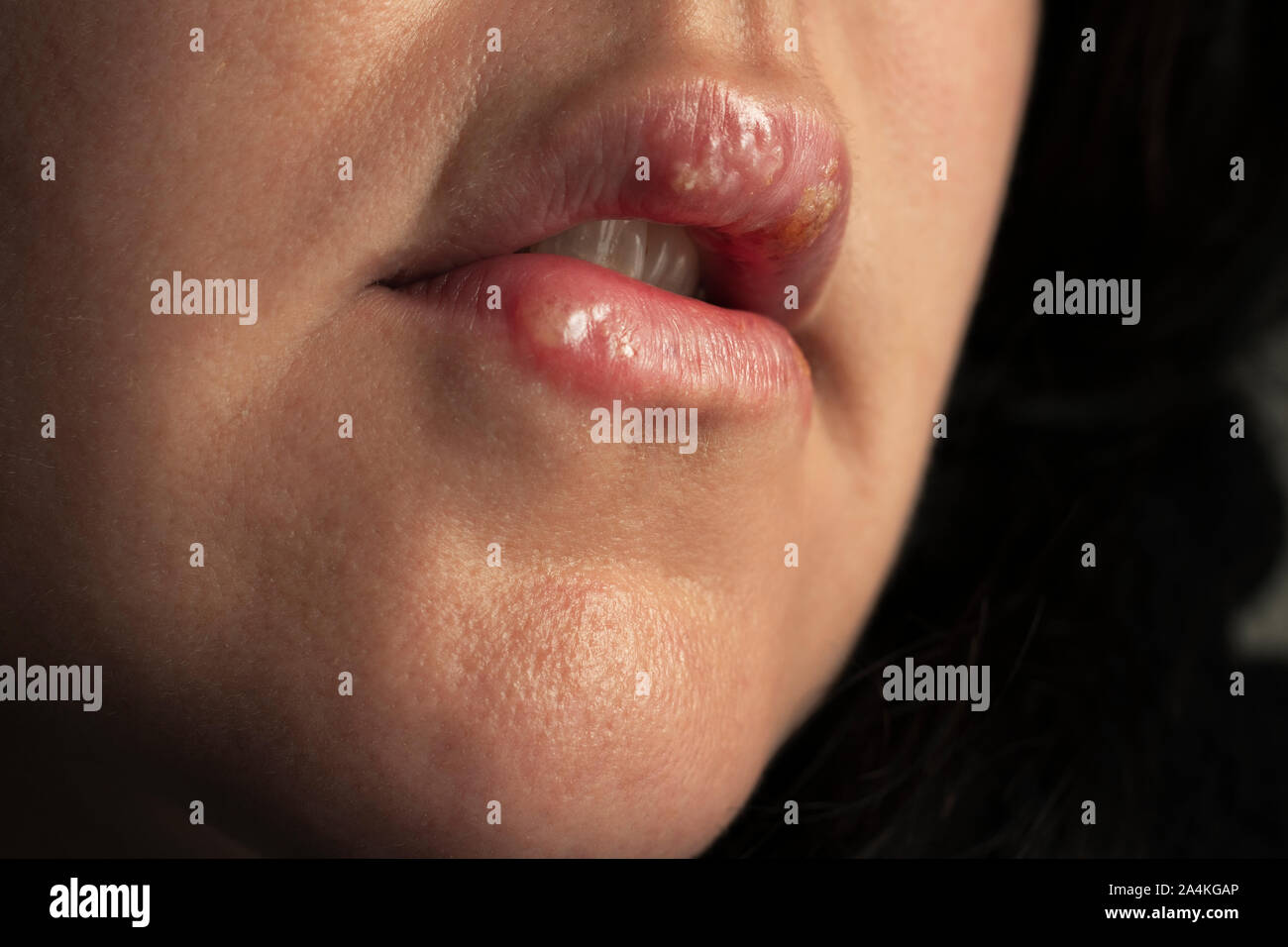In prossimità di una signora con più coldsores su entrambi le sue labbra Foto Stock