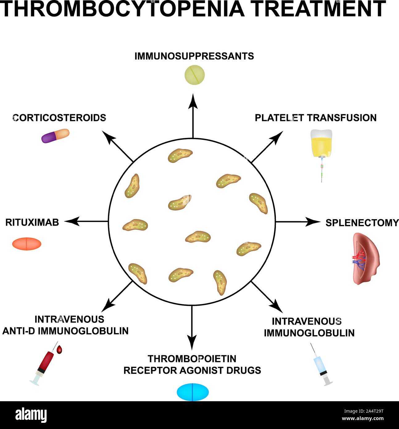 Il trattamento di trombocitopenia. Abbassamento delle piastrine nel sangue. Infographics. Illustrazione Vettoriale su sfondo isolato. Illustrazione Vettoriale