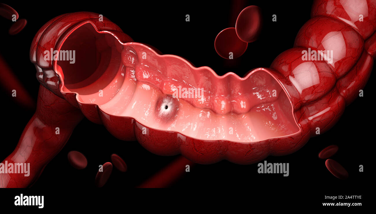 Ulcera peptica, 3d illustrazione di stomaco umano anatomia Foto Stock