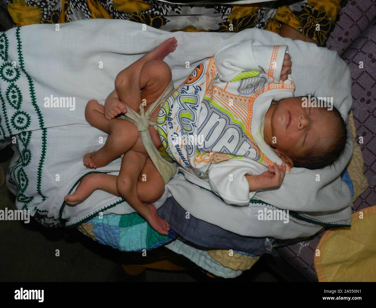 A sei zampe bambino neonato nato a Sukkur pochi anni fa, essendo trattata a istituto nazionale della salute dei bambini NICH a Karachi il lunedì 16 aprile, 2012. Foto Stock