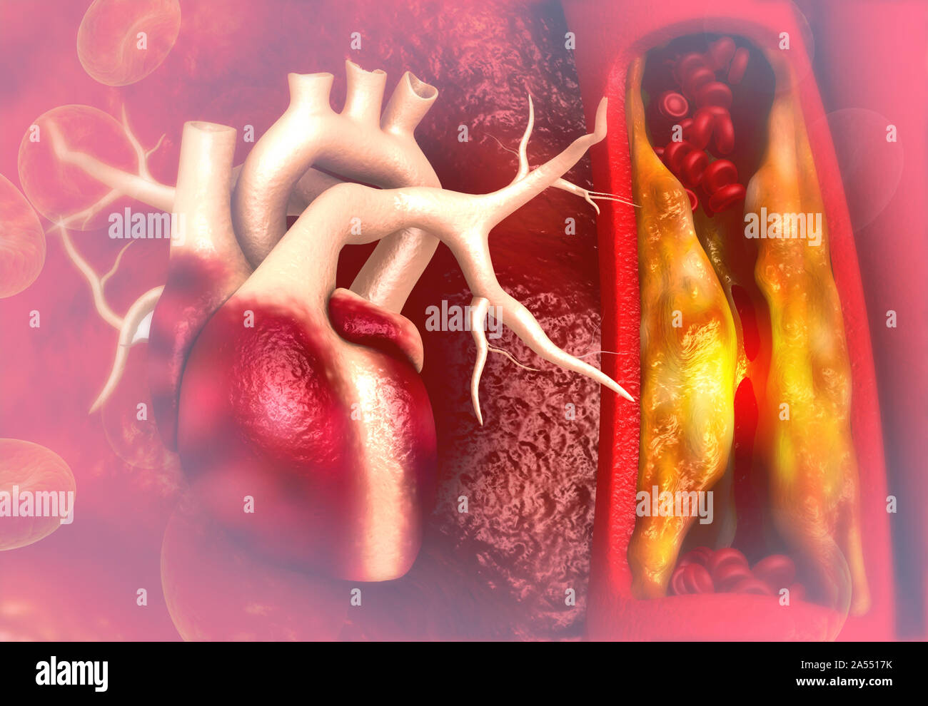 Placca di colesterolo in arteria con cuore umano anatomia. 3d illustrazione Foto Stock