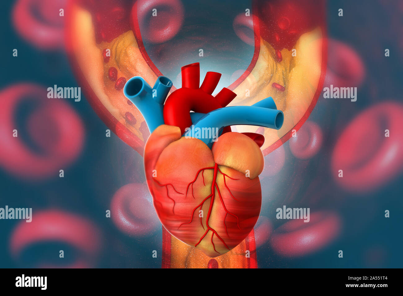 Placca di colesterolo in arteria con cuore umano anatomia. 3d illustrazione Foto Stock
