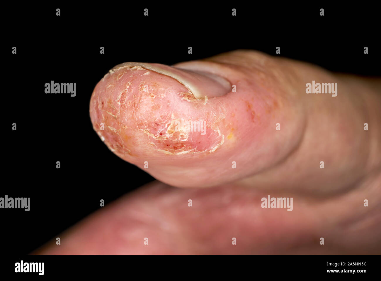 Primo piano della dermatite eczema eruzione cutanea allergica sul pollice maschio con peeling della pelle. . Isolato su sfondo nero. Macro. Profondità di campo. Foto Stock