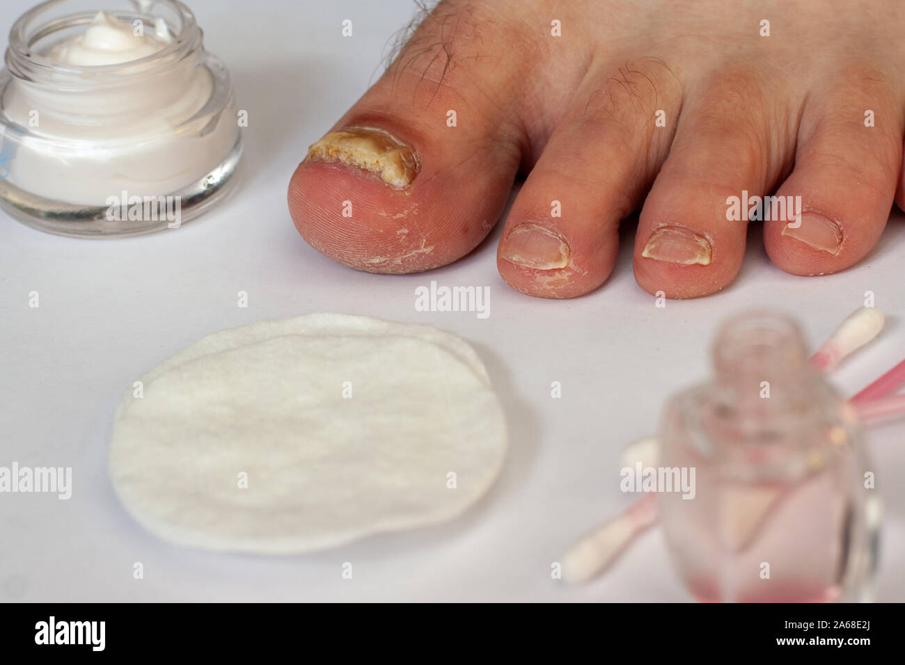 Toenail colpite dal fungo. La cura delle unghie. La crema in un vasetto, tamponi di cotone e batuffoli di cotone. Messa a fuoco selettiva. Sfondo bianco. Foto Stock