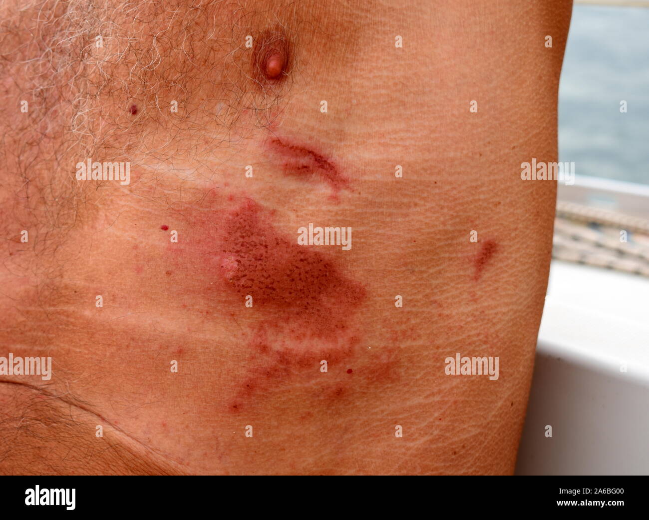 Pelagia Noctiluca meduse sting segni su un uomo al torace Foto Stock