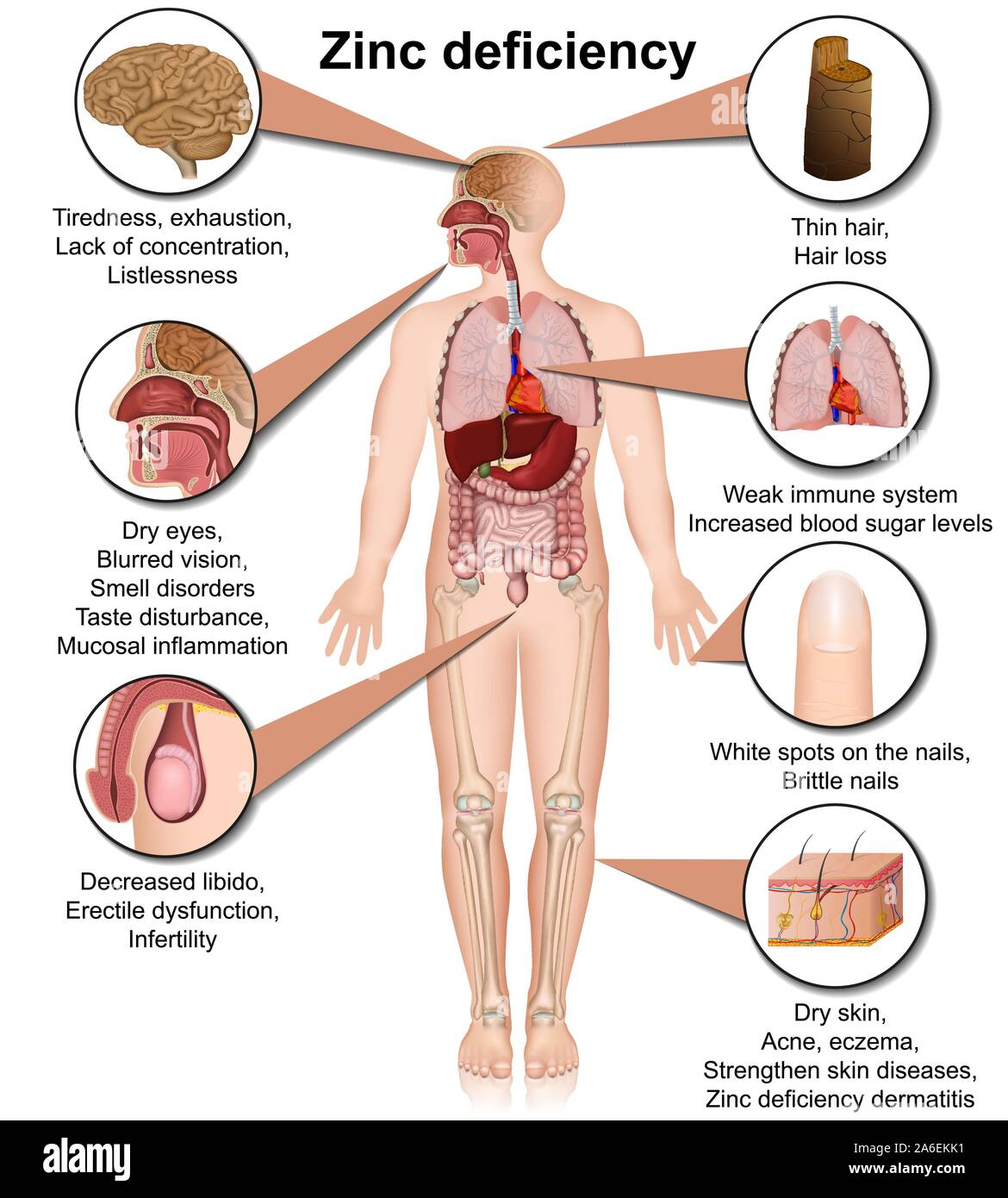 La carenza di zinco 3d medical illustrazione vettoriale isolati su sfondo bianco Una infografica Illustrazione Vettoriale
