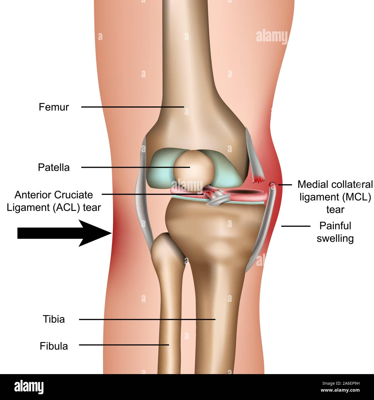 Dislocato del ginocchio, legamento mediale collaterale medico strappo illustrazione vettoriale isolati su sfondo bianco Illustrazione Vettoriale