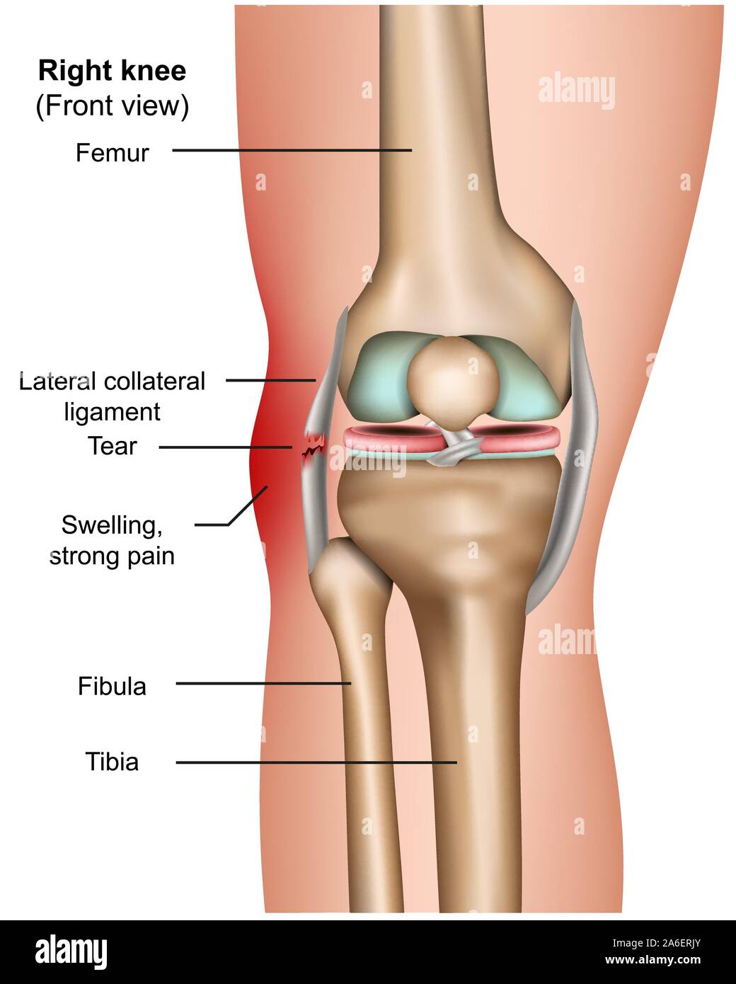 Materiale collaterale laterale lacerazione 3d medical infografico vettore isolato su sfondo bianco Illustrazione Vettoriale