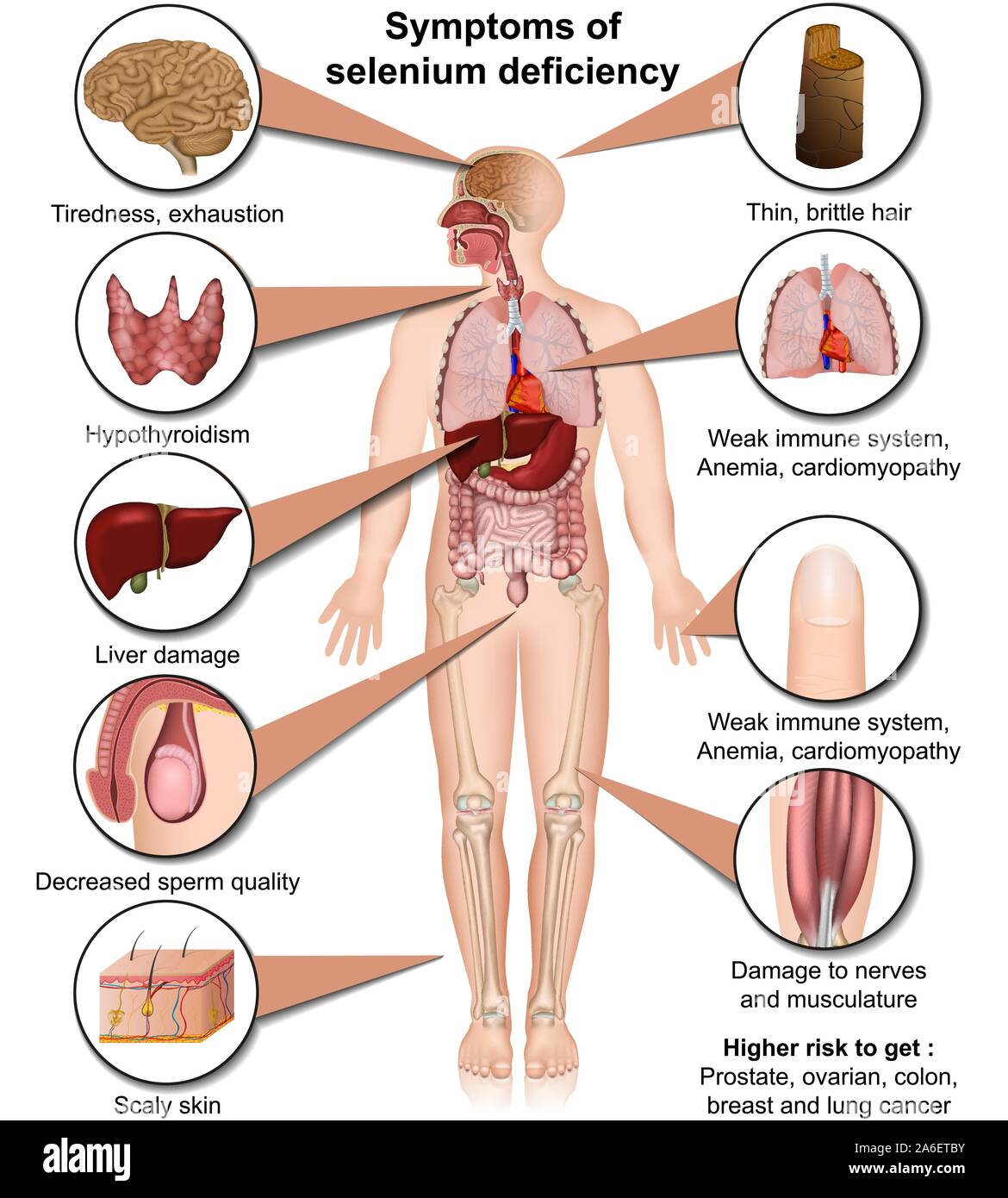 Una carenza di selenio medical illustrazione vettoriale isolati su sfondo bianco Una infografica Illustrazione Vettoriale