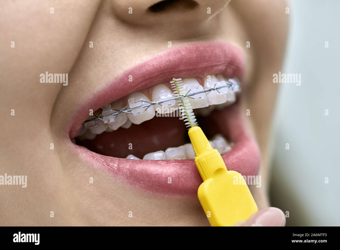 La donna sta mostrando i suoi denti con bretelle in una clinica dentale. Dentista di pulizia è il suo sistema di staffa con un aiuto di un pennello speciale. Macro pho orizzontale Foto Stock