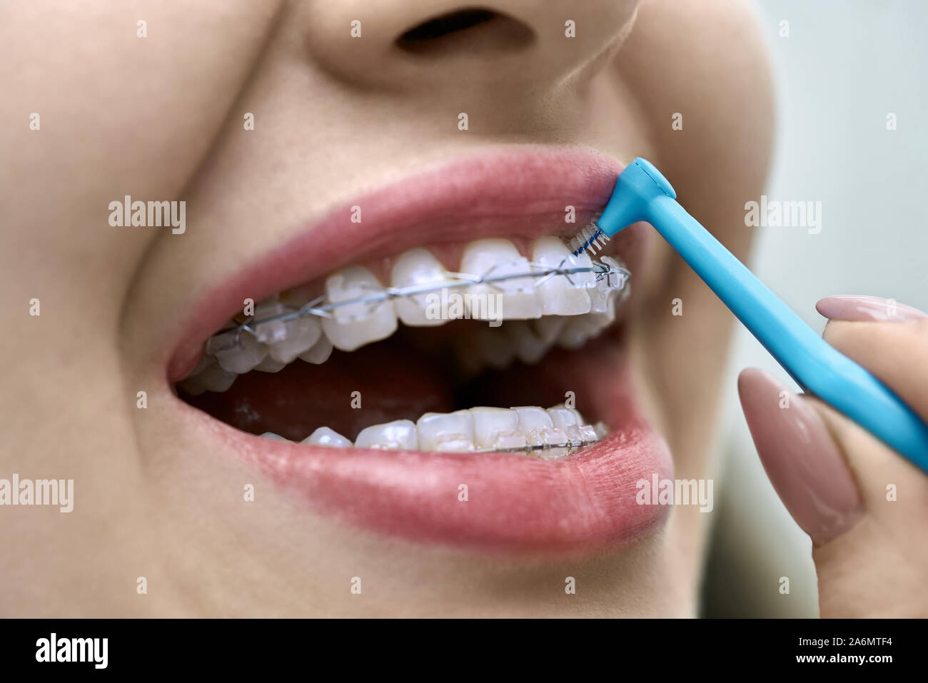 Bella ragazza sta mostrando i suoi denti con bretelle in una clinica dentale. Dentista di pulizia è il suo sistema di staffa con un aiuto di un pennello speciale. Macro horizont Foto Stock