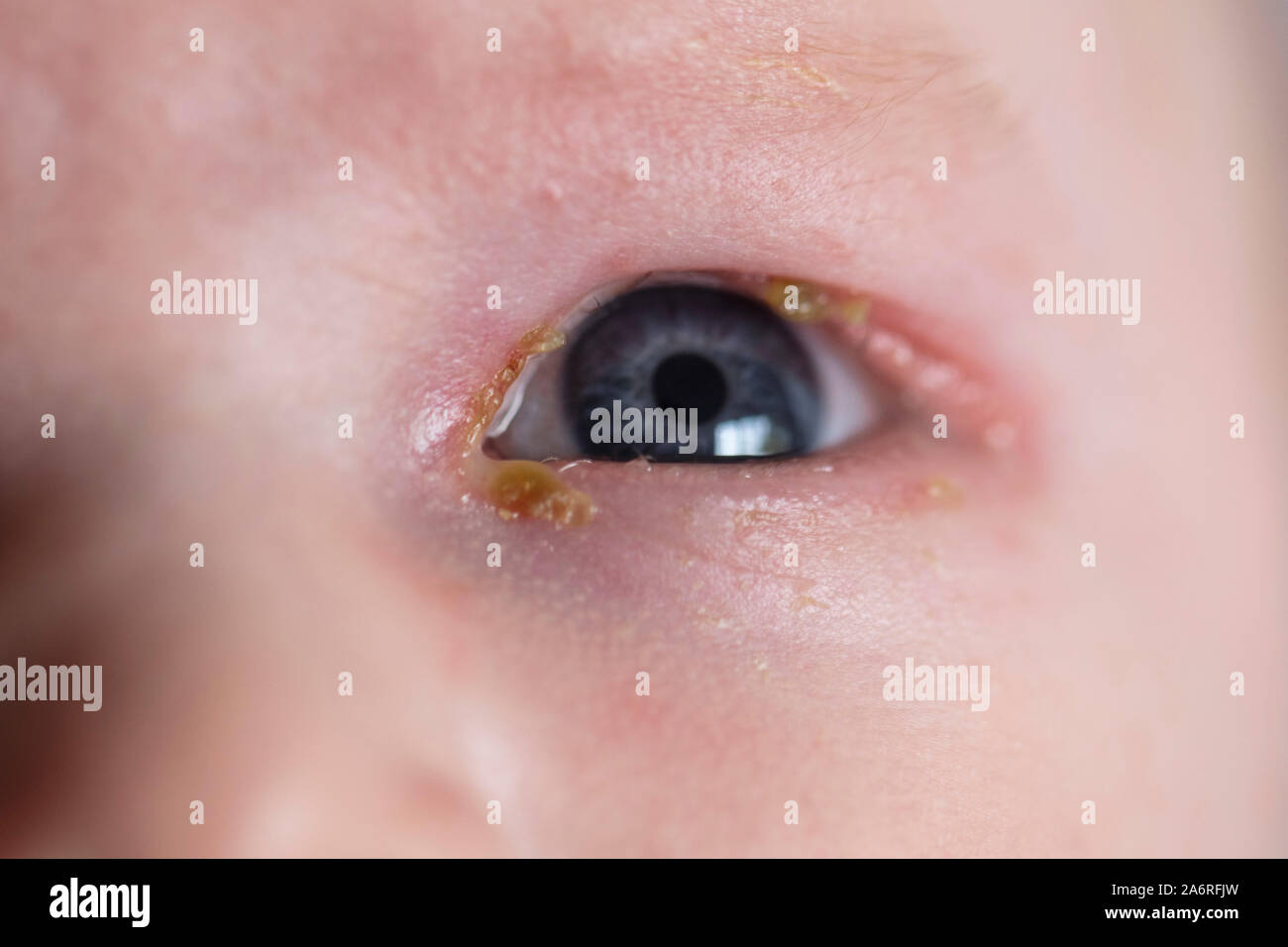 Una chiusura di un giovane bambino con un comune mal di sticky infezione degli occhi Foto Stock