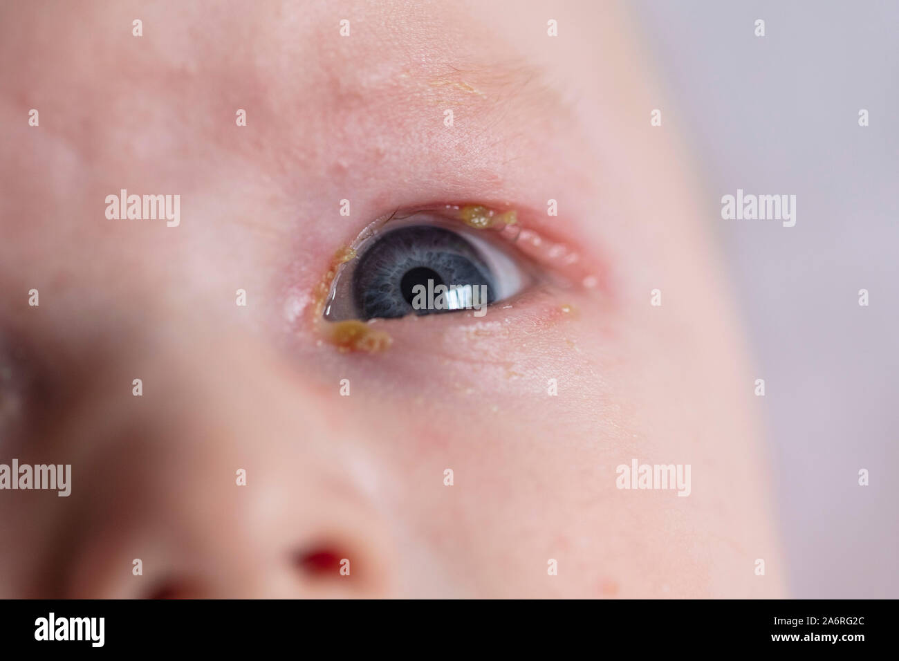 Una chiusura di un giovane bambino con un comune mal di sticky infezione degli occhi Foto Stock