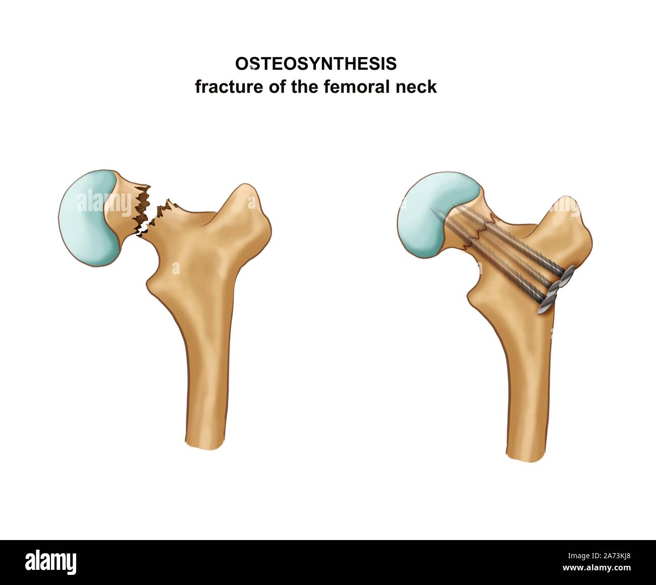 Illustrazione della frattura del collo femorale. Osteosintesi Foto Stock