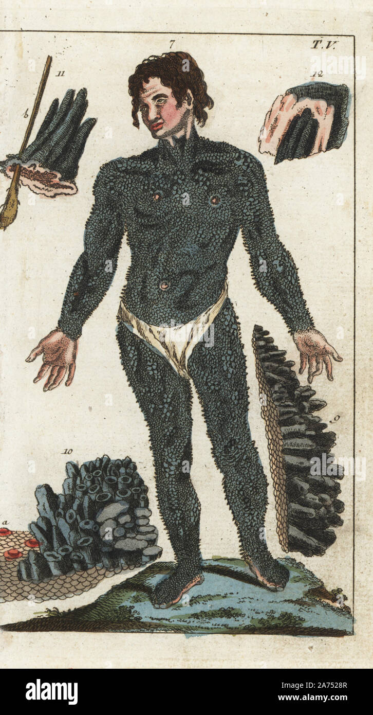 Inglese John Lambert (22) esposto i suoi porcupine disturbo della pelle, ittiosi hystrix, in Leipzig. Giovanni era un discendente di Edward Lambert, la cui condizione è stata descritta per la prima volta da Machin nel 1732. Handcolored incisione su rame da G. T. Wilhelm 'Enciclopedia di Storia Naturale: l'umanità", Augsburg, 1804. Gottlieb Tobias Wilhelm (1758-1811) era un pastore bavarese e naturalista è noto come il tedesco Buffon. Foto Stock